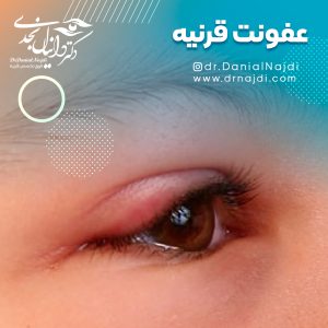 عفونت در قرنیه